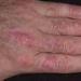 Симптомы псориаза ногтей (фото) и лечение